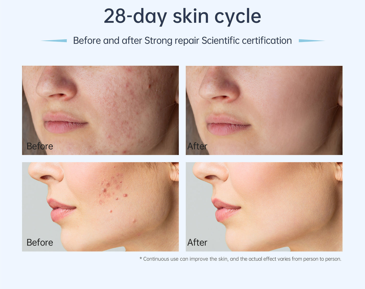 a woman with acne on her face