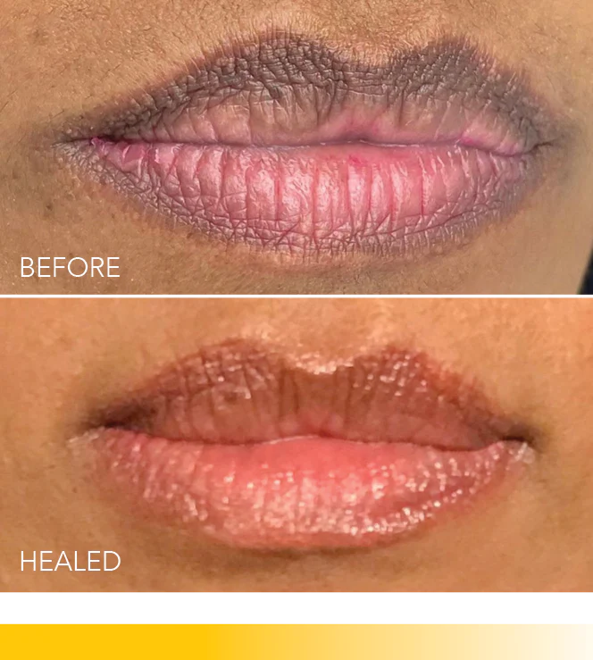 a woman's lips before and after lip fillers