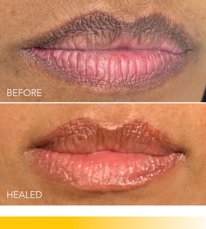 a woman's lips before and after lip fillers