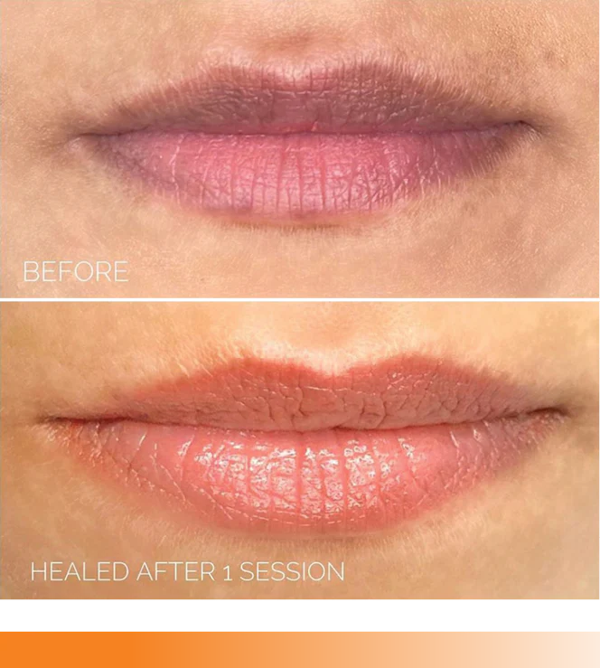 a woman's lips before and after lip fillers