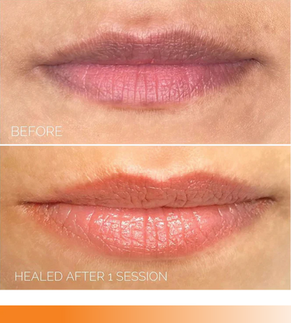 a woman's lips before and after lip fillers