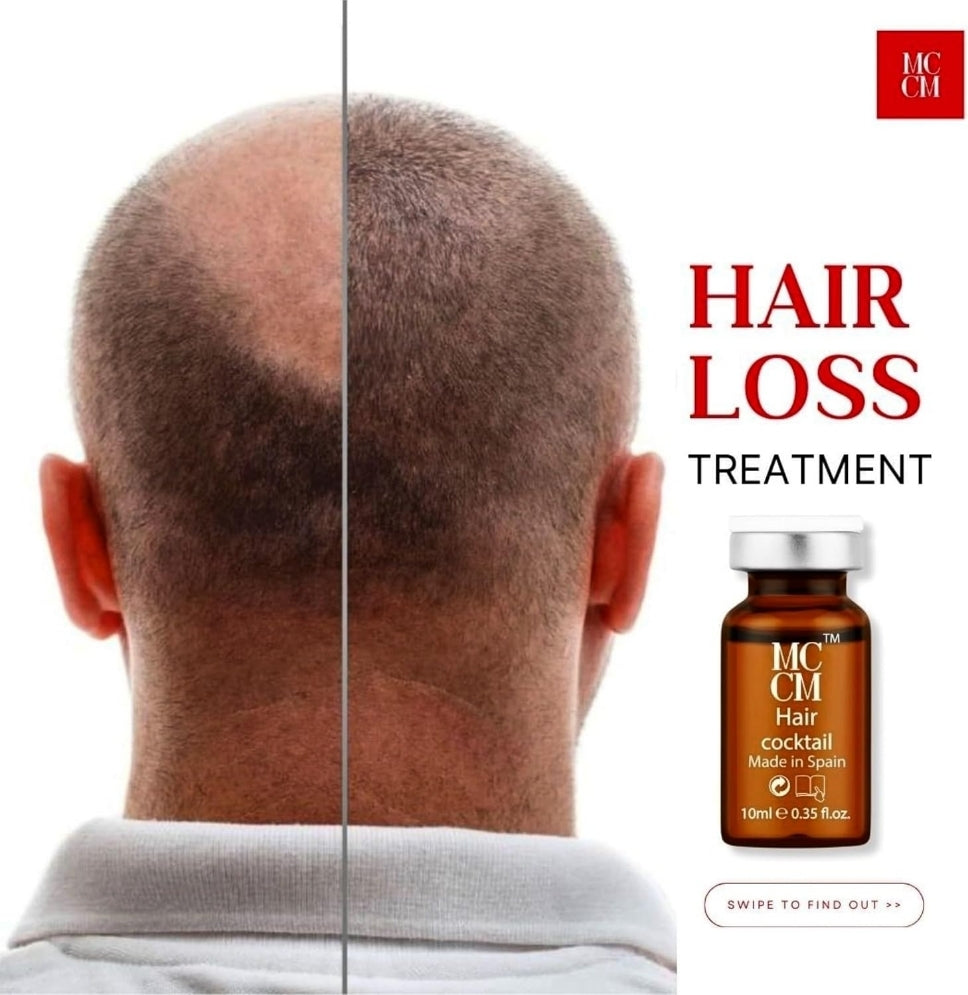 Before and after comparison showcasing the effectiveness of MCCM Hair Cocktail Meso Serums for hair loss treatment. The image features a close-up of a person’s scalp showing noticeable hair regrowth on one side and thinning hair on the other. The product, MCCM Hair Cocktail, is prominently displayed, emphasizing its role in revitalizing hair. The text 'HAIR LOSS TREATMENT' highlights the product's purpose.