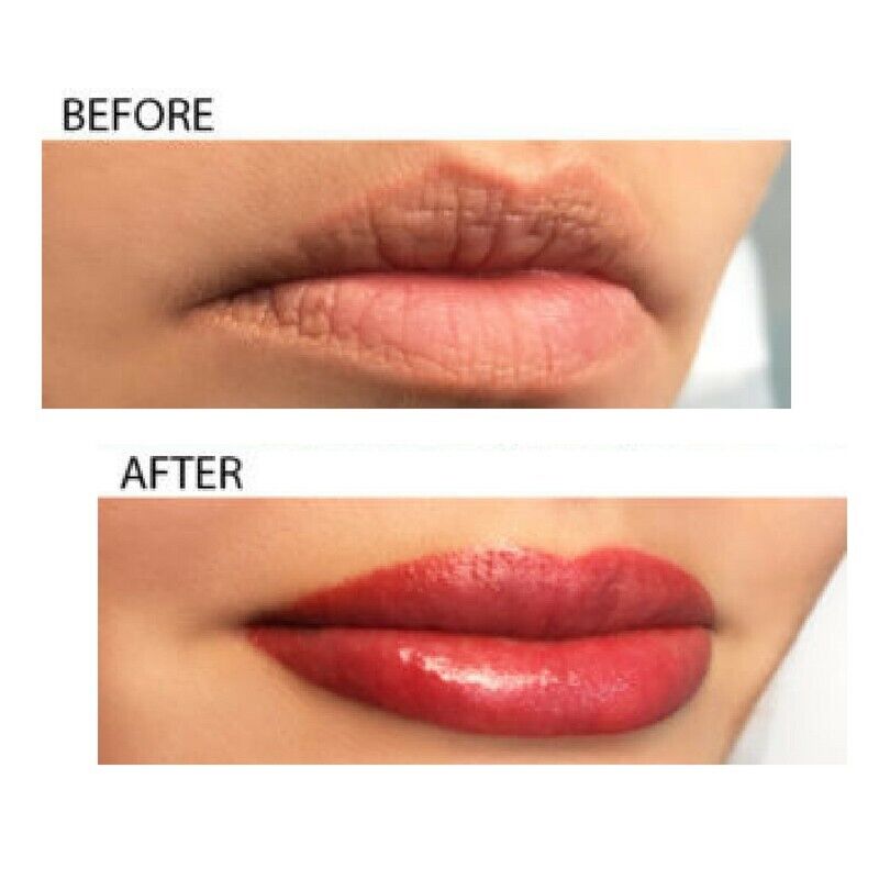 a woman's lips before and after lip fillers